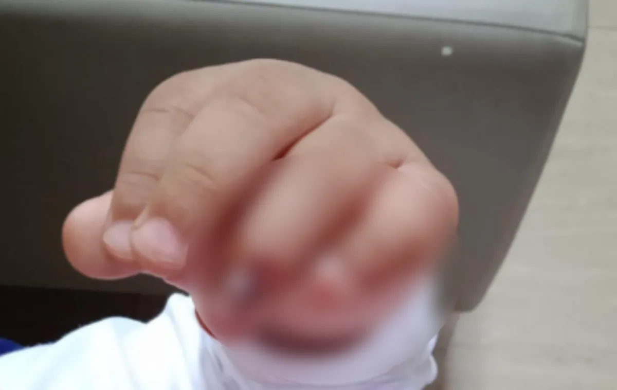 Mão de bebê presa em brinquedo de parquinho, indenização por acidente em área pública.