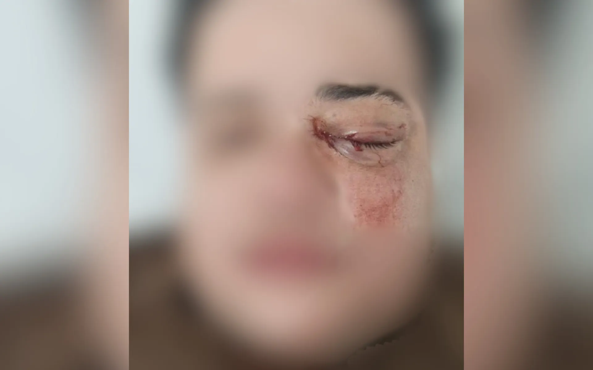 Mulher vítima de agressão com olho ferido