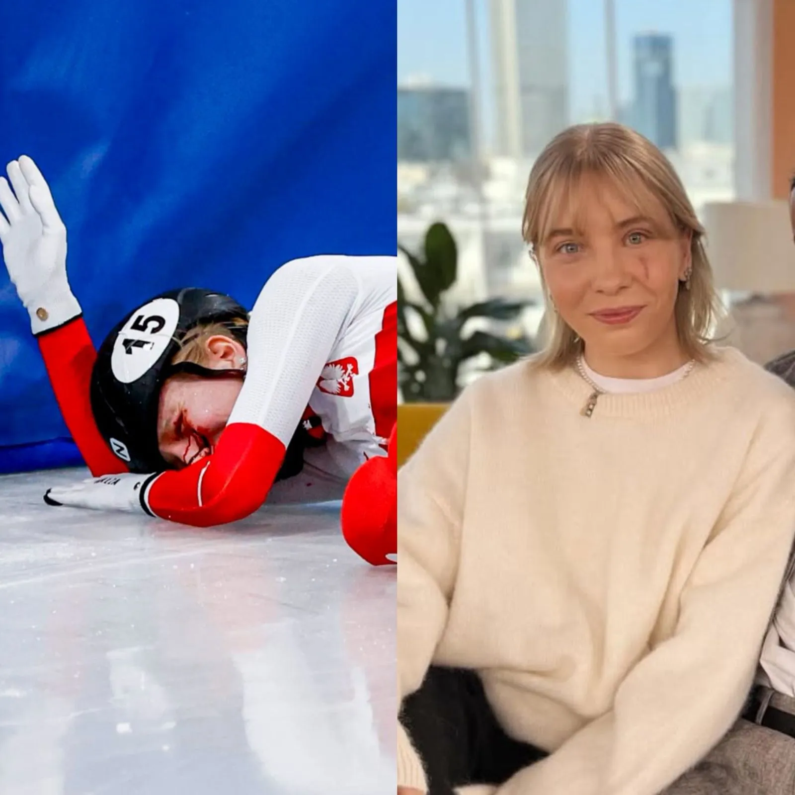 Patinadora Kamila Sellier com cicatriz no rosto após acidente de lâmina na patinação de velocidade