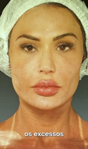 Gracyanne Barbosa: entenda sua mudança em procedimentos estéticos