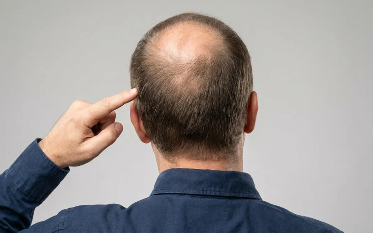 Cabelos saudáveis na área doadora para transplante