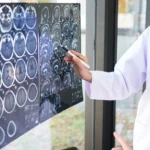 Pessoa com expressão de estresse, simbolizando gatilhos para AVC