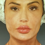 Gracyanne Barbosa com rosto natural após remover preenchimentos