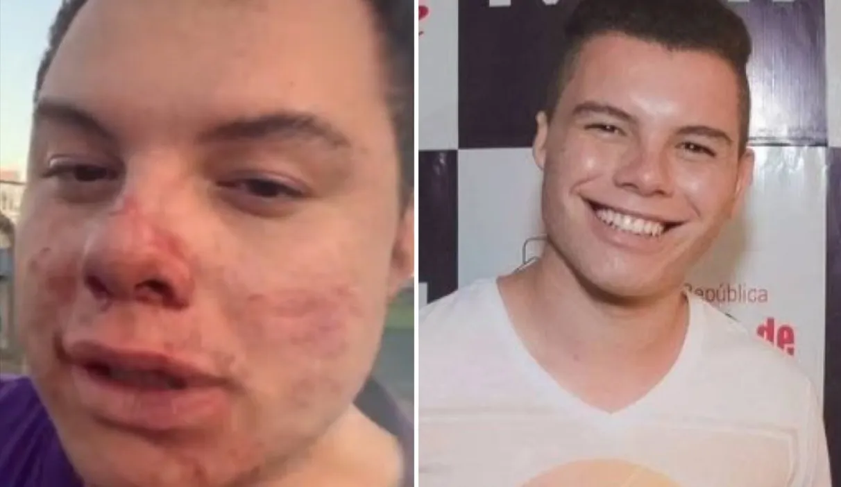 Influencer Clóvis Roberto em recuperação na UTI, após agressão