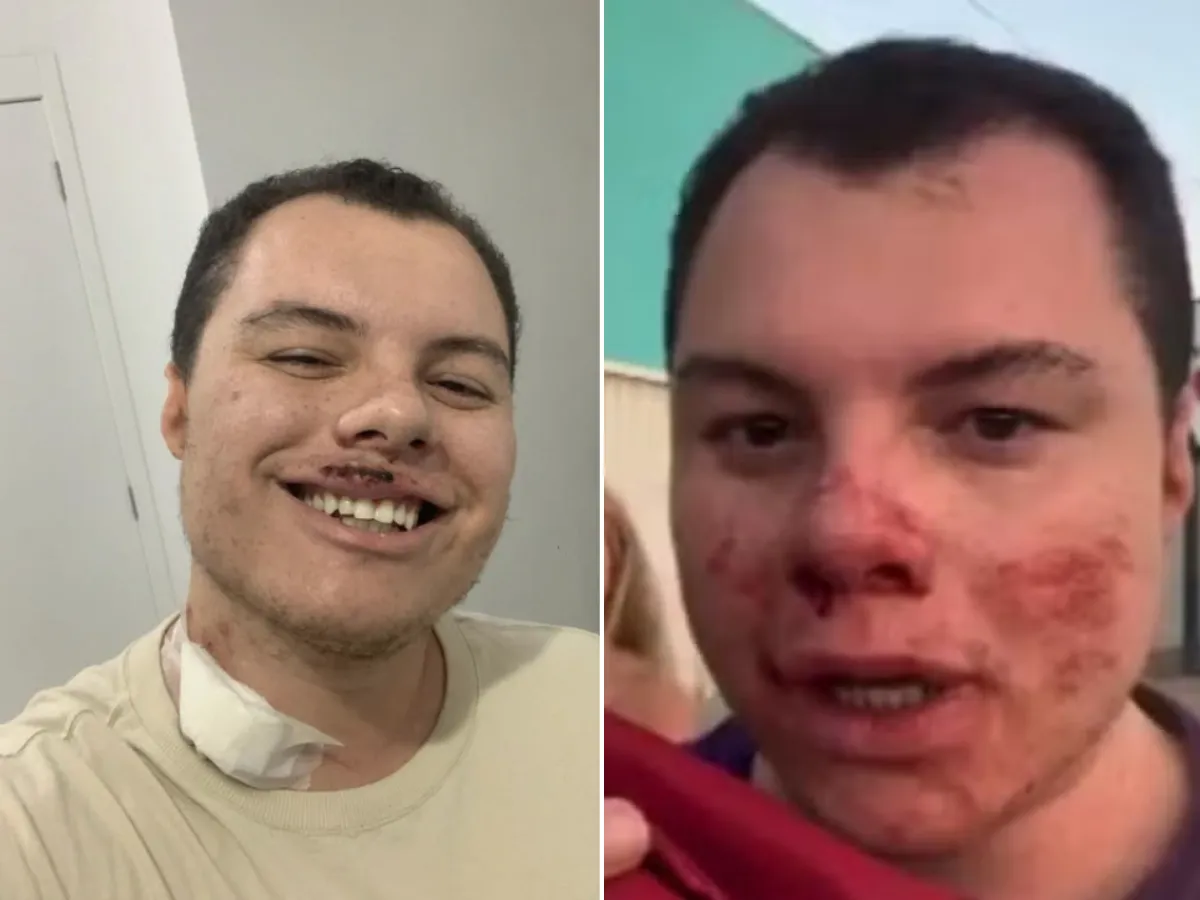 Clóvis Roberto de Leão, influenciador agredido, em recuperação