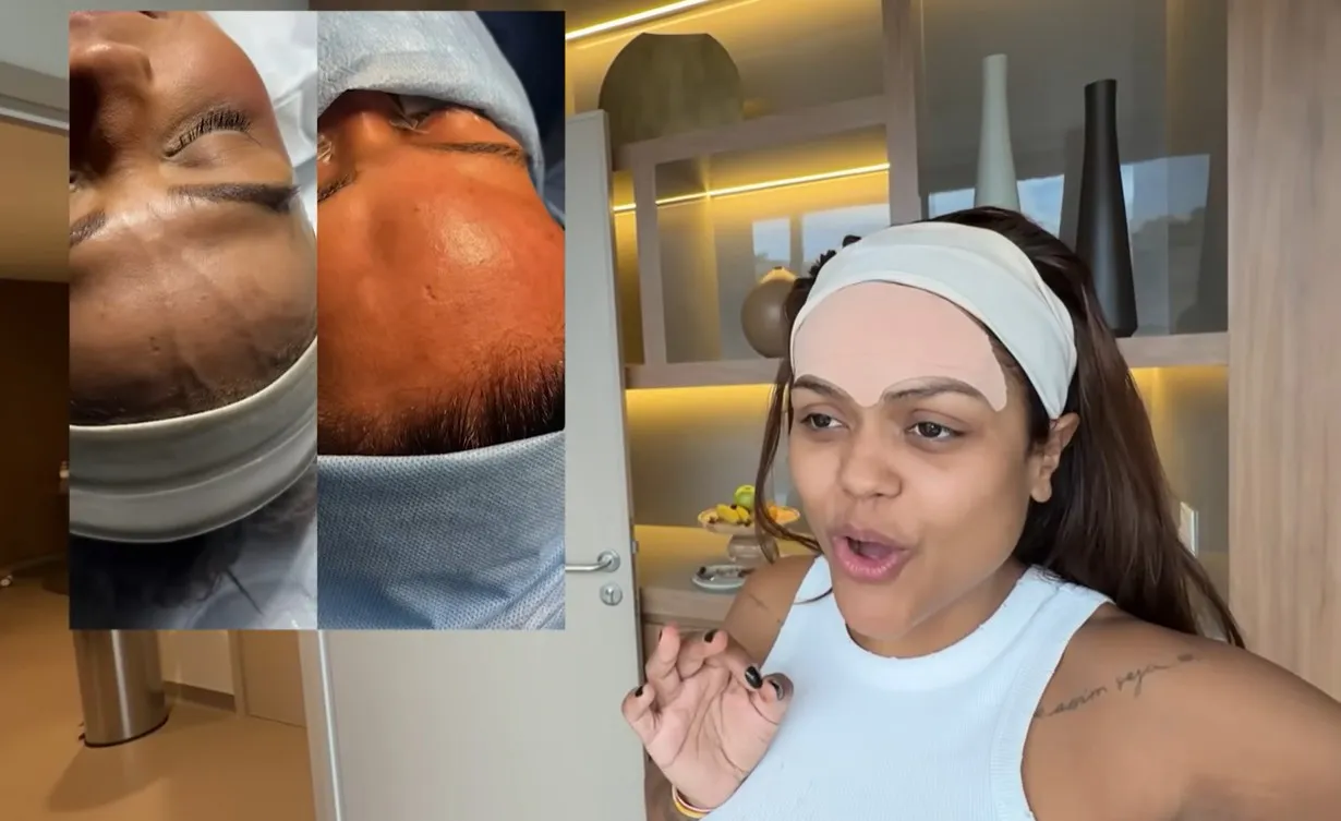 Mulher com veia na testa, antes e depois da remoção