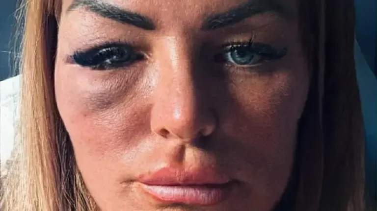 Mulher com lesões faciais após agressão de lutador de MMA