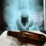 Profissional de saúde segura objetos seguros para uso anal, prevenindo riscos de objetos presos no reto.