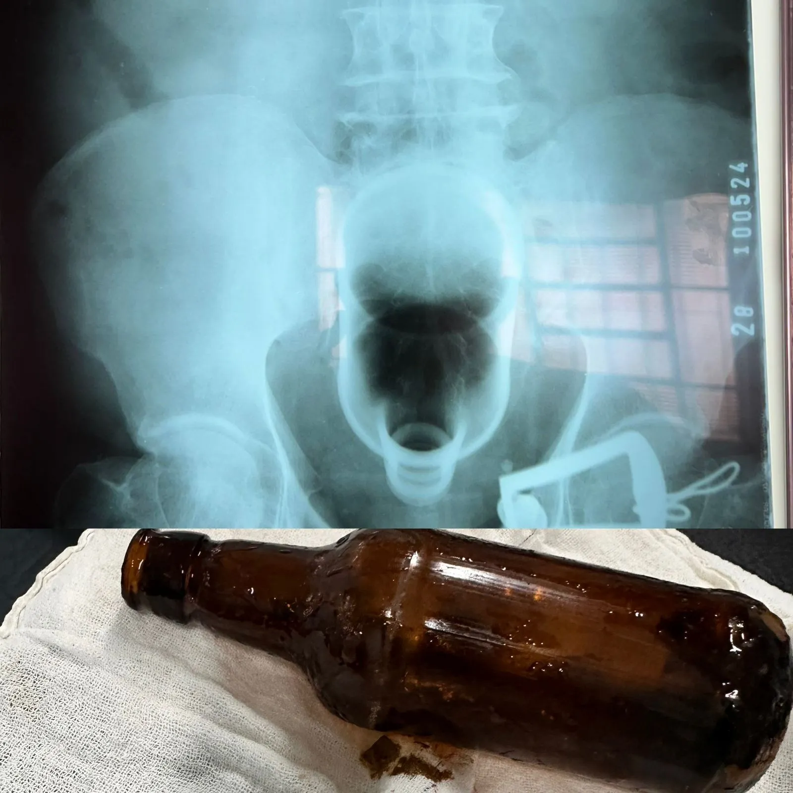 Profissional de saúde segura objetos seguros para uso anal, prevenindo riscos de objetos presos no reto.