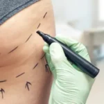 Fotografia de uma mulher com foco na região do bumbum, representando os riscos e a popularidade da cirurgia de BBL.