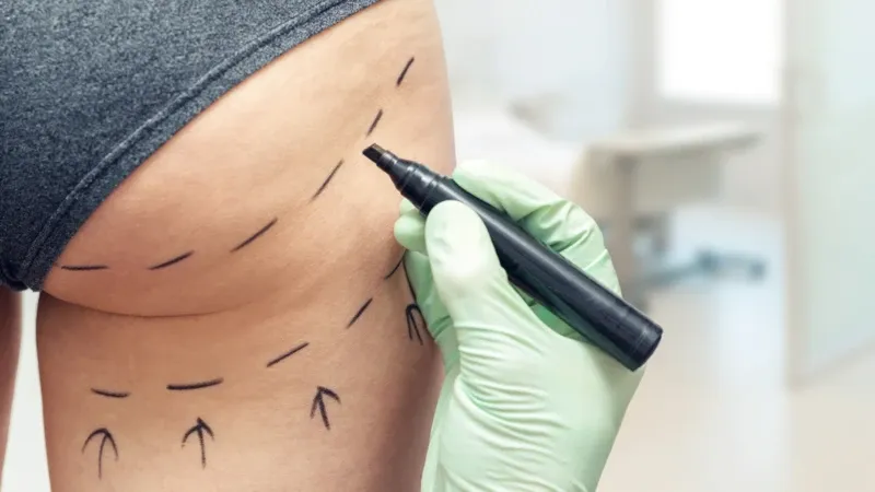 Fotografia de uma mulher com foco na região do bumbum, representando os riscos e a popularidade da cirurgia de BBL.