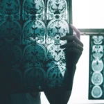 Cérebro humano com proteínas tau se espalhando, doença de Alzheimer